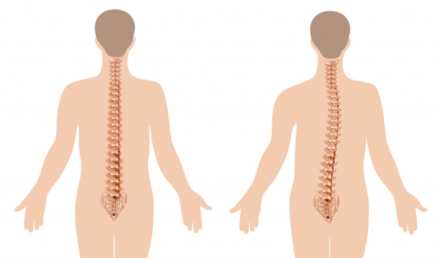 manifestacija osteohondroze